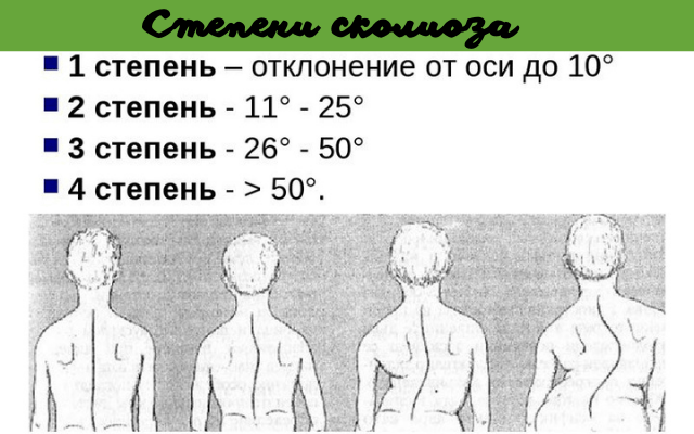 Степени сколиоза