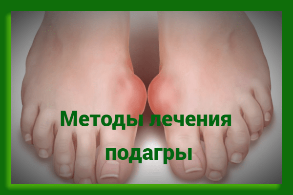 Методы лечения подагры