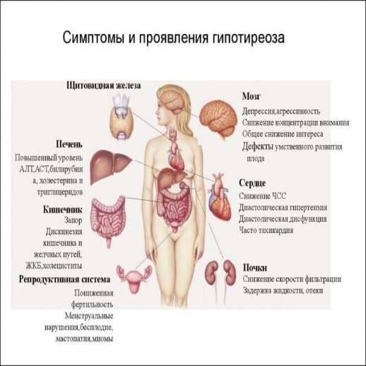 Гипотиреоз