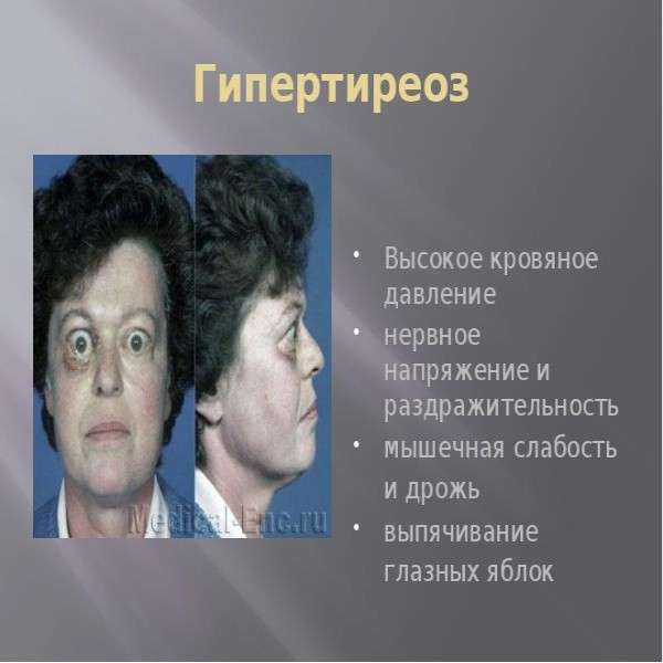 Гипертиреоз